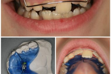 Съемные аппараты в ортодонтии