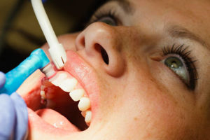 Чистка зубного налета